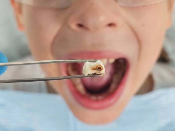 Best Emergency Tooth Extraction in St James, NY