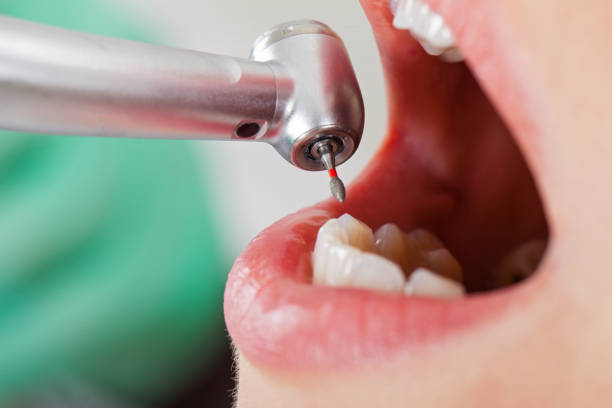 Best Emergency Broken Tooth Repair in St James, NY